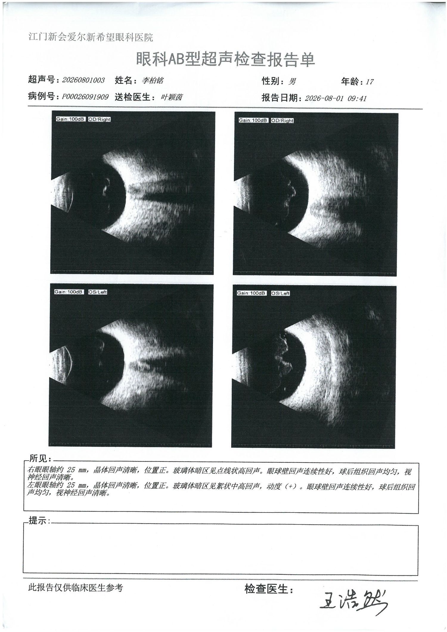 2026-08-01 B 超：左眼玻璃体条状混浊