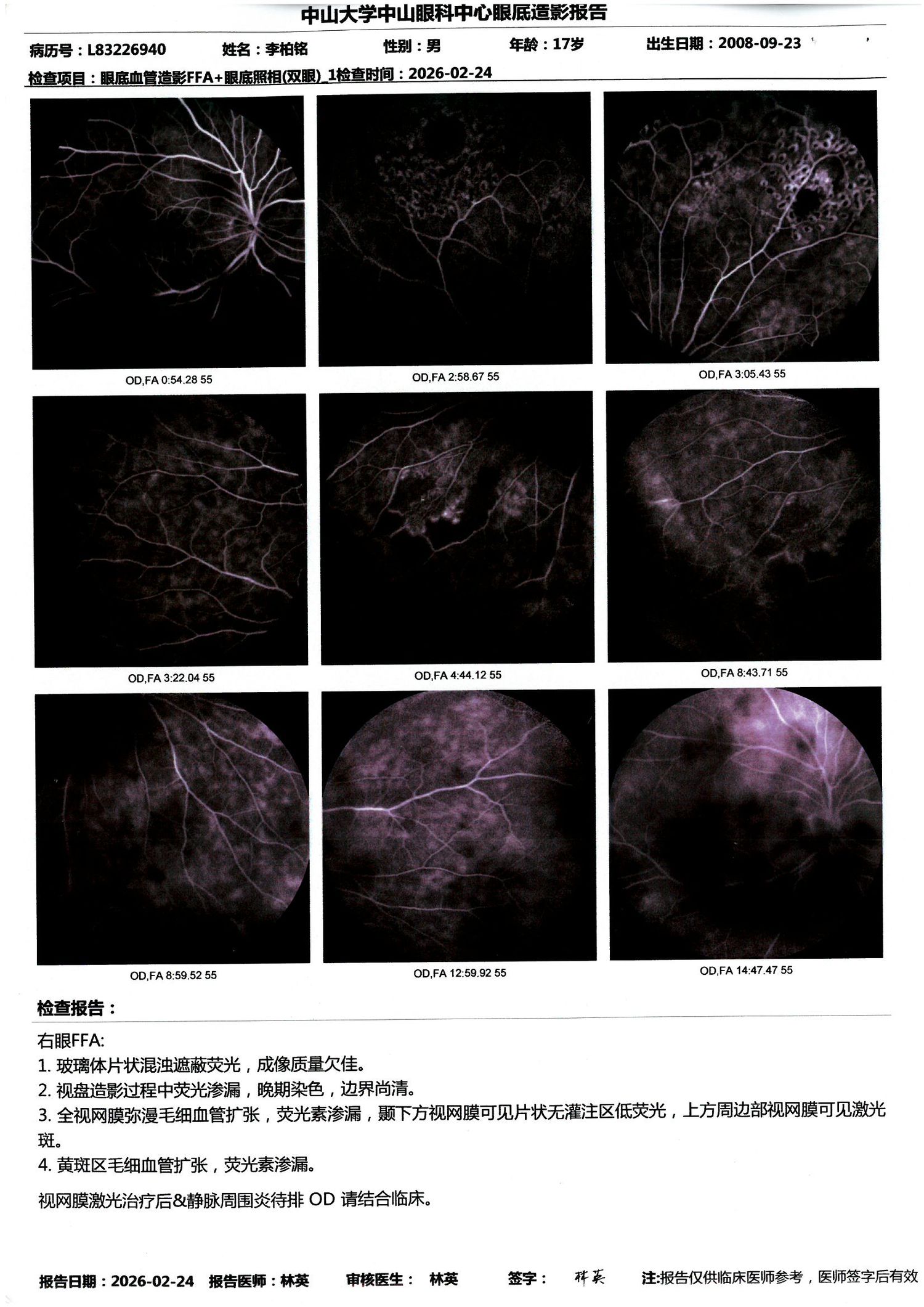 2026-02-24 右眼 FFA：弥漫毛细血管扩张、荧光素渗漏，下方周边无灌注