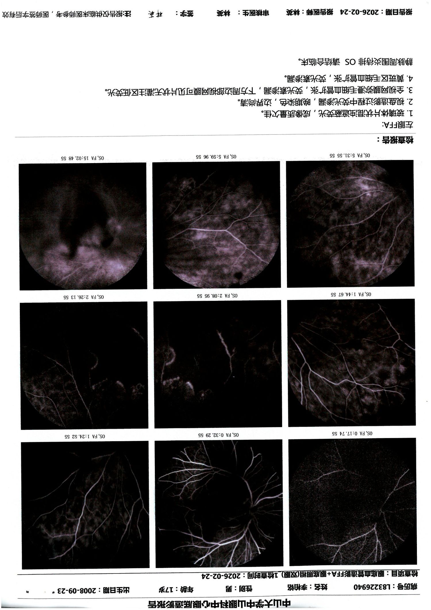 2026-02-24 左眼 FFA：同前，全视网膜弥漫渗漏