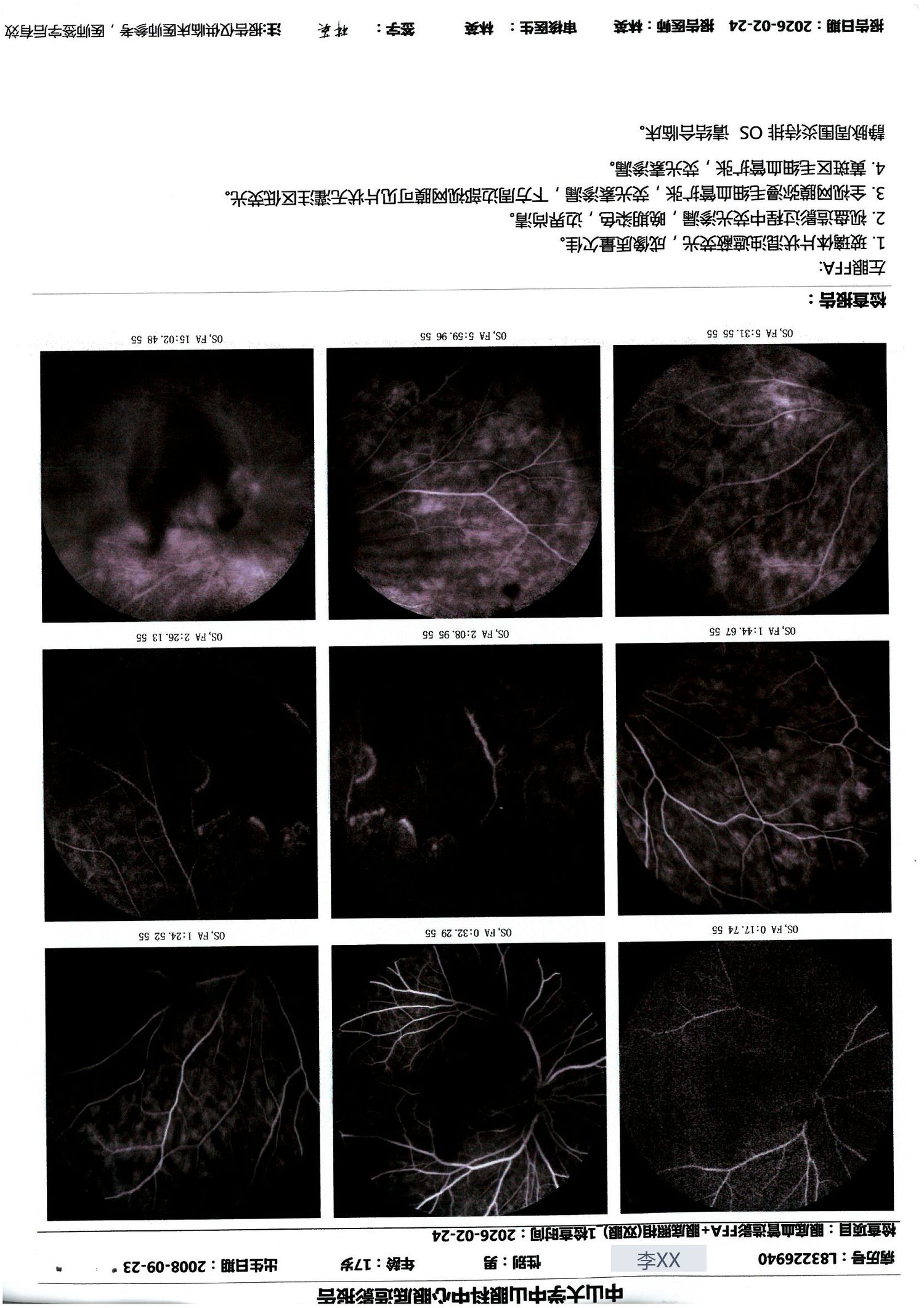 2026-02-24 左眼 FFA：同前，全视网膜弥漫渗漏