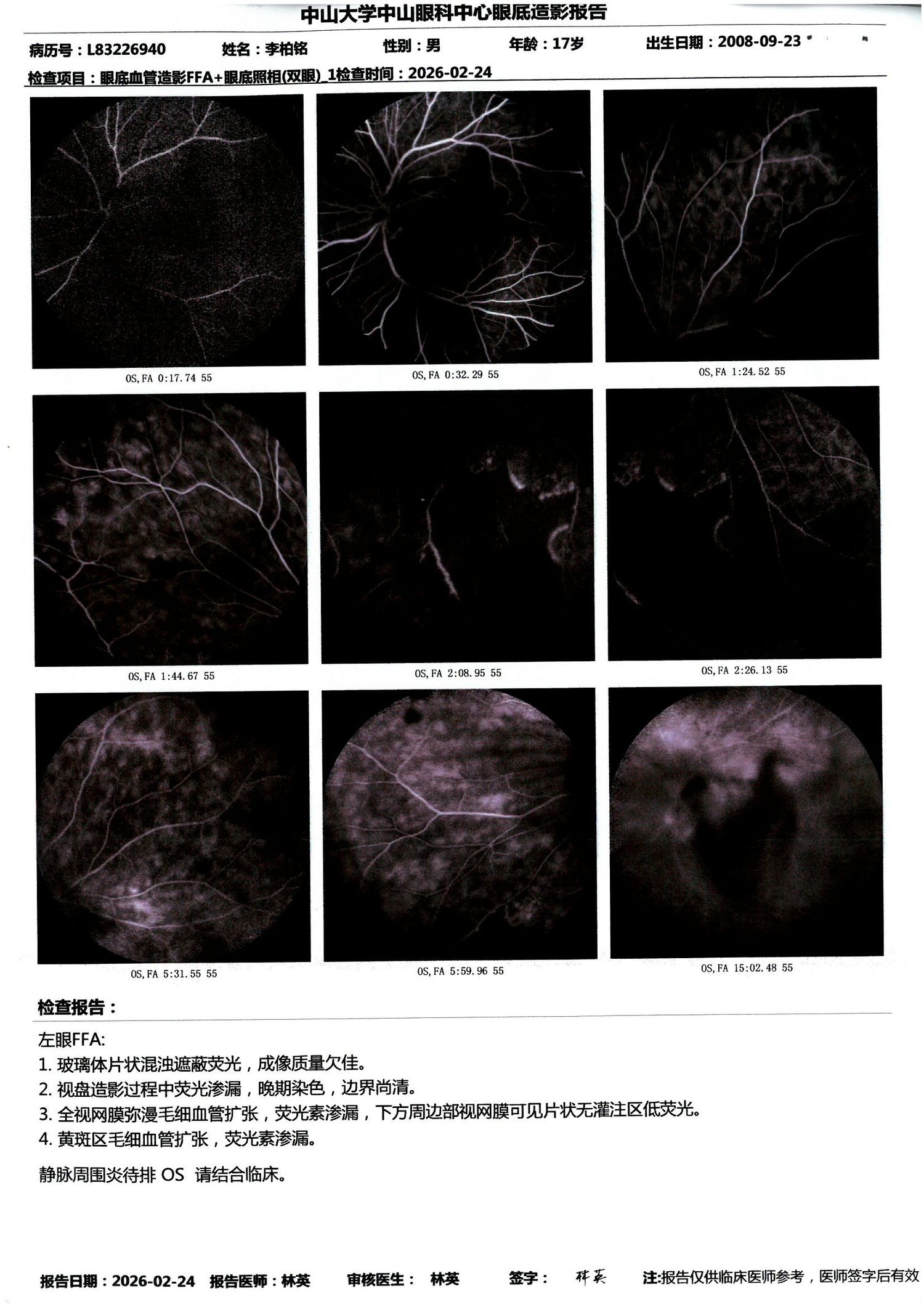 2026-02-24 左眼 FFA：同前，全视网膜弥漫渗漏